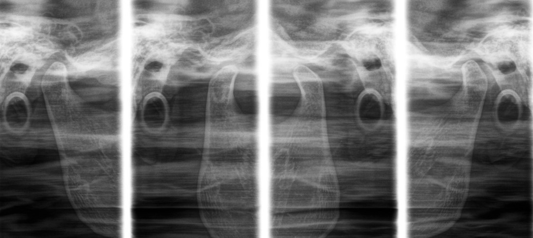 Radiografias da articulação temporomandibular em vista lateral, em boca aberta e fechada