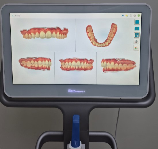 Escâner intraoral exibindo o modelo digital 3D das arcadas em várias vistas