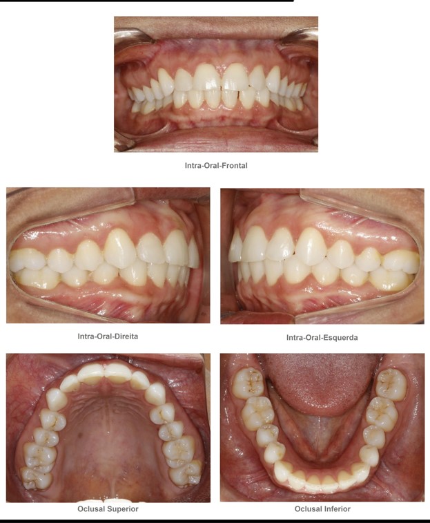 Conjunto de fotografias intraorais: frontal, laterais direita e esquerda, oclusal superior e inferior