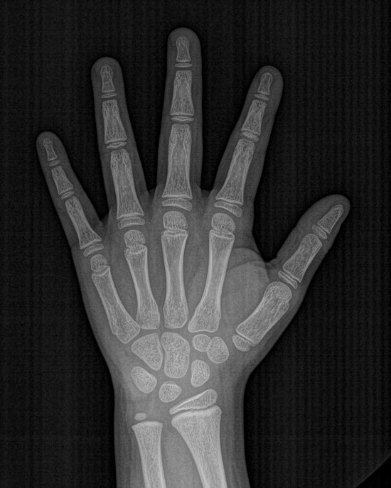 Radiografia carpal da mão e do punho usada para estimar a idade óssea