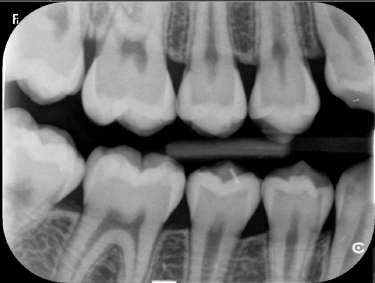 Radiografia interproximal bite-wing mostrando o contato entre os dentes posteriores