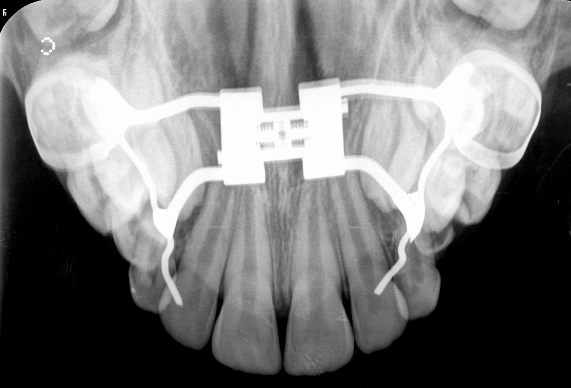 Radiografia oclusal da maxila com aparelho expansor instalado