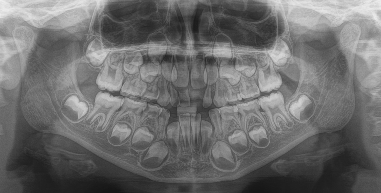 Radiografia panorâmica mostrando as duas arcadas em dentição mista
