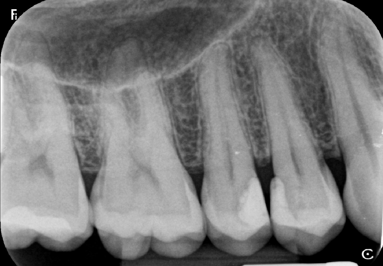 Radiografia periapical em detalhe, mostrando coroas, raízes e o osso ao redor dos dentes