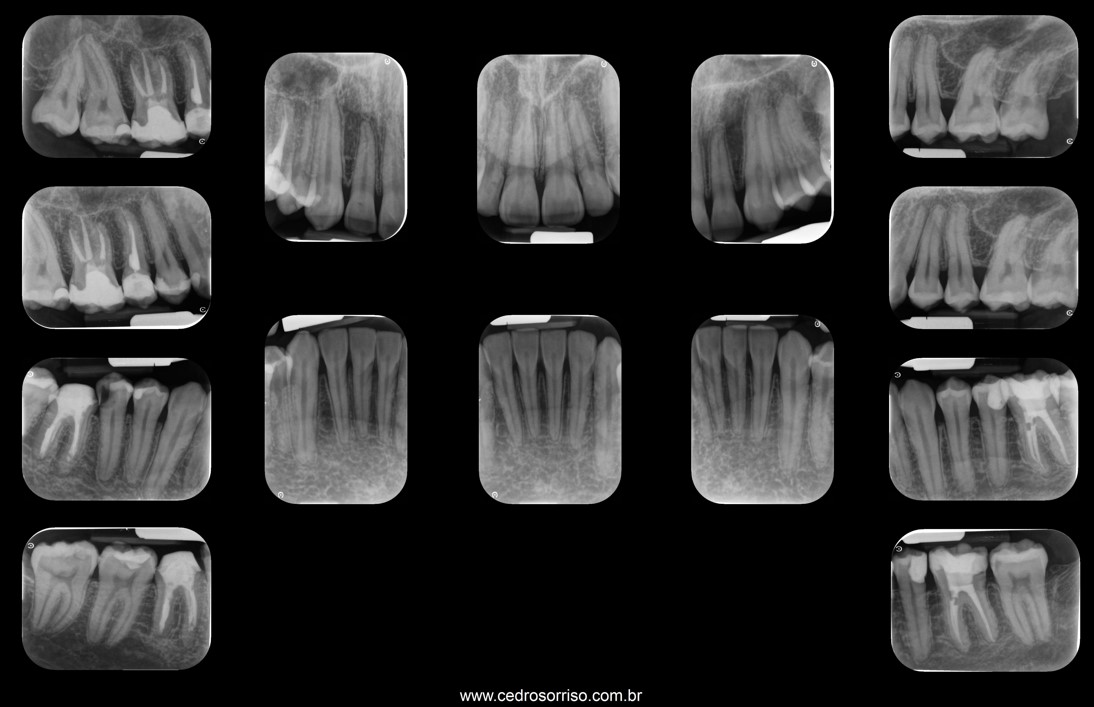 Série periapical completa com quatorze radiografias cobrindo toda a boca