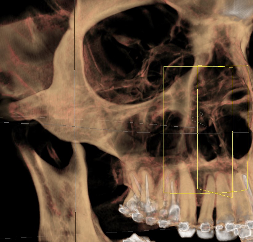 Tomografia Cone Beam em 3D com o corte sagital demarcado na região posterior da maxila