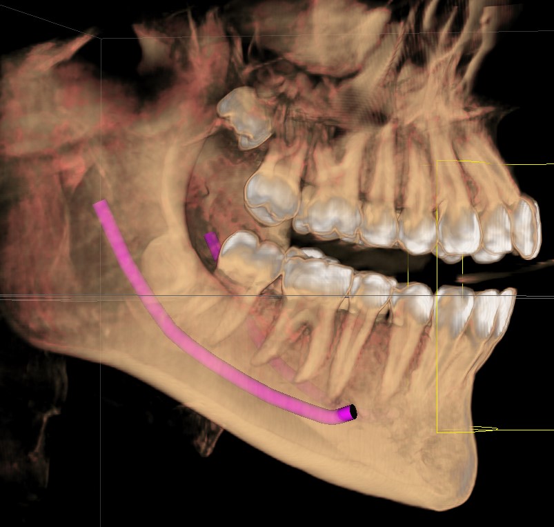 Reconstrução 3D de tomografia Cone Beam feita na CEDRO, com o trajeto do canal mandibular mapeado